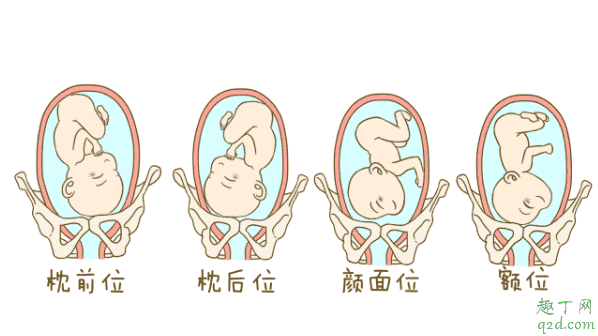 懷孕七個(gè)月寶寶臀位怎么糾正 單胎臀位不能順產(chǎn)嗎3