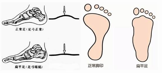 扁平足能跑步嗎？扁平足跑步有什么危害？