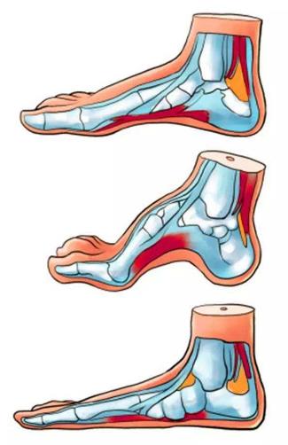 扁平足能跑步嗎？扁平足跑步有什么危害？